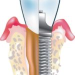 Zubař Ostrava: Kde si nechat udělat zubní implantáty?
